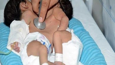 الاطباء الايرانيون ينجحون في عملية فصل توأمين ملتصقين